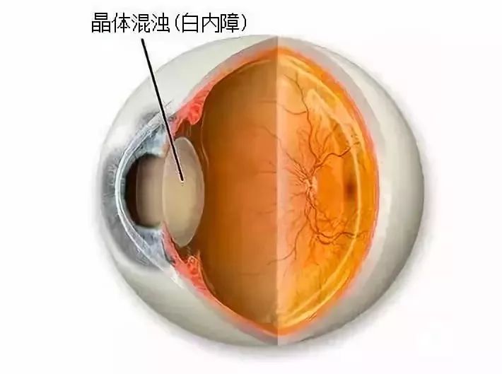 玻璃体混浊最新特效药，突破与创新的治疗策略揭秘