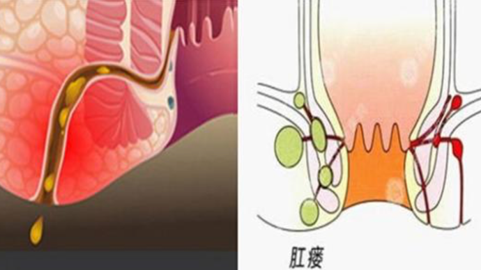 肛瘘最新治疗方法，自信与成就感的源泉