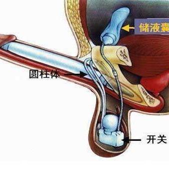 最新阴茎假体植入价格详解，手术费用、影响因素全面解析