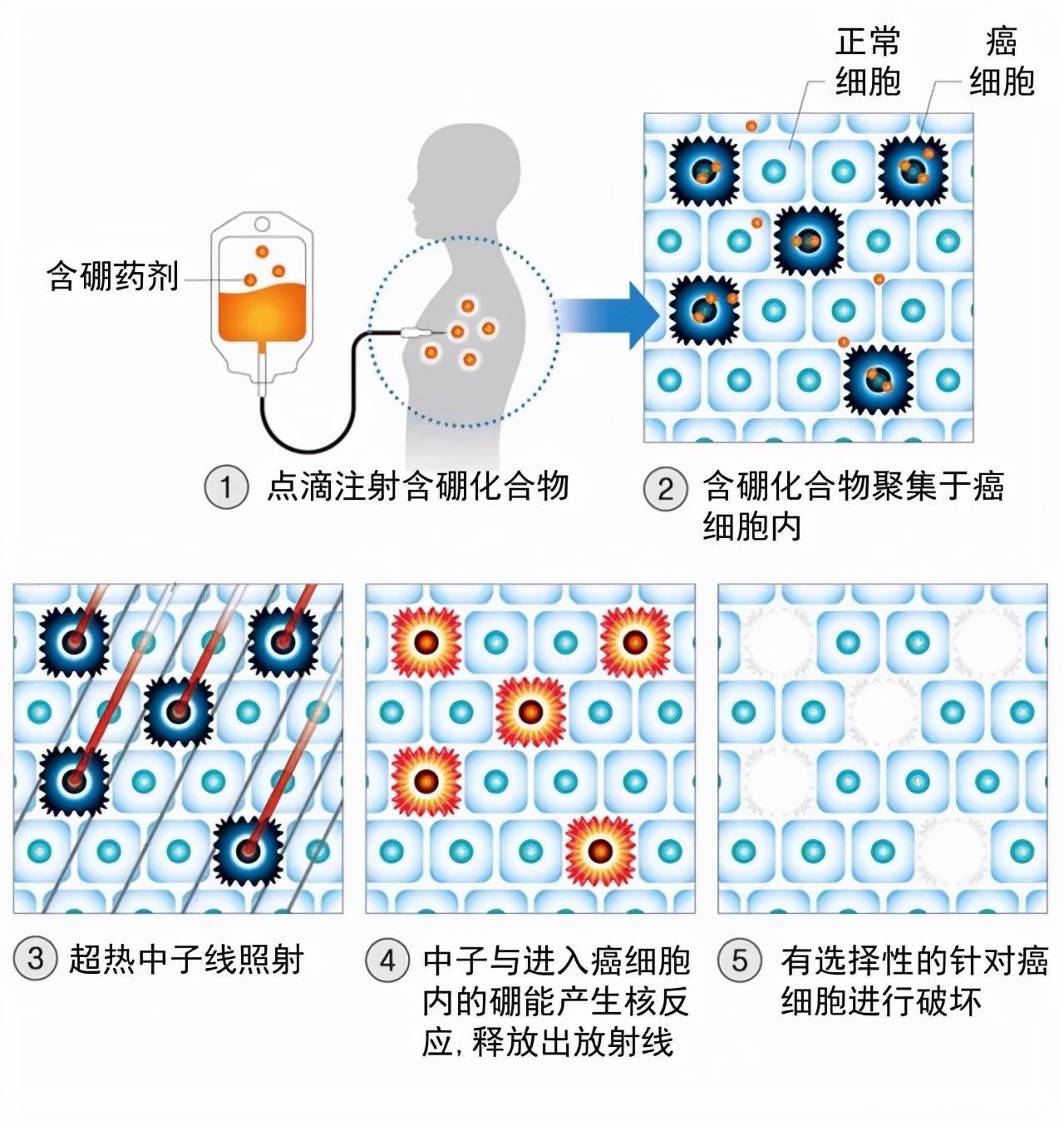 硼中子治疗肿瘤最新进展与观点论述揭秘