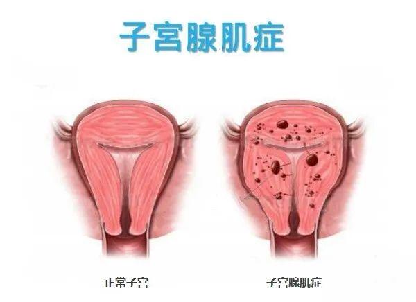 科技之光照亮女性健康之路，子宫腺肌症最新治疗方法探索