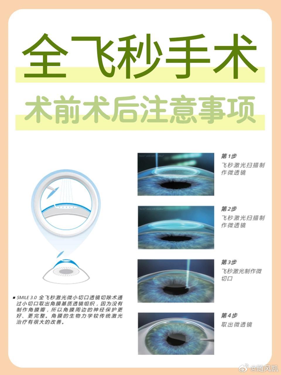 近视手术最新技术，重塑视界，引领科技革新生活